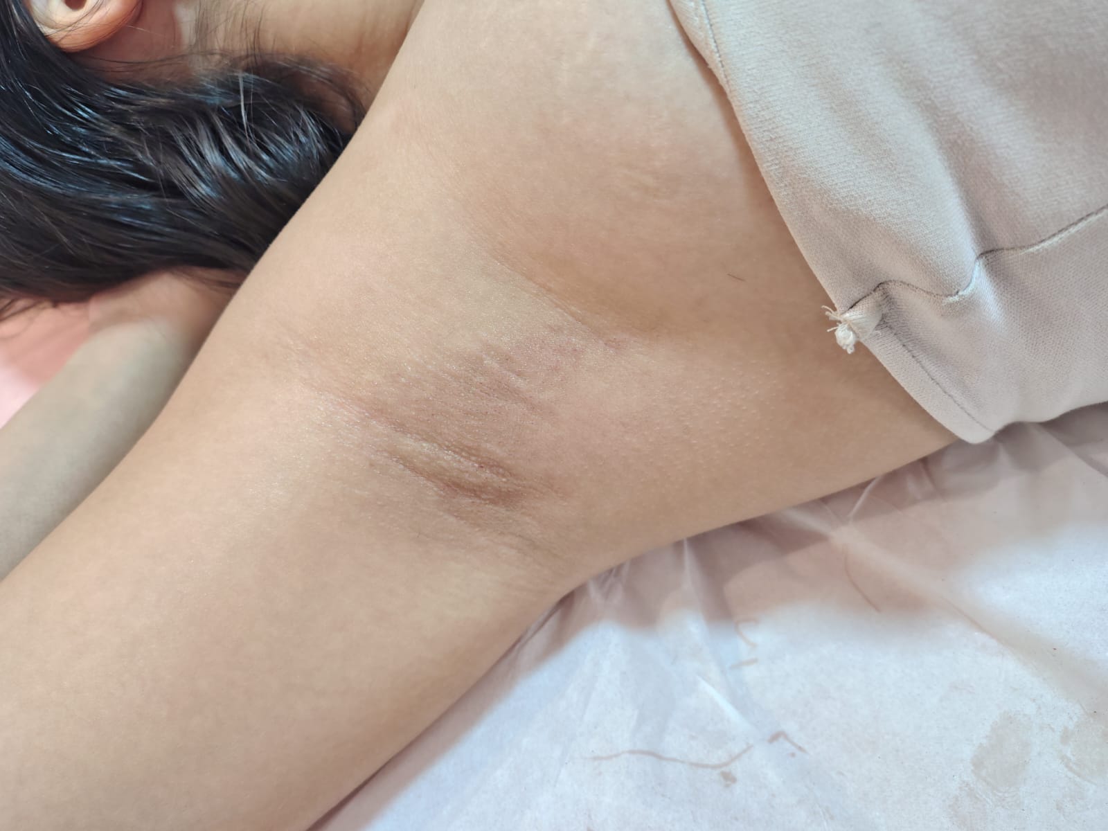 Axila lisinha e livre de pelos após epilação